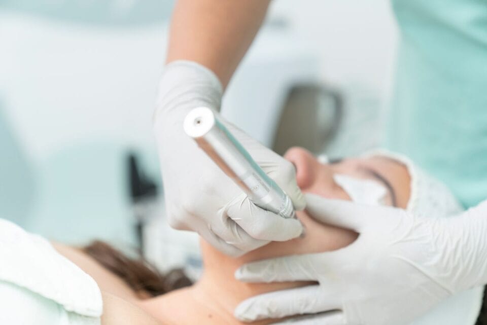 OPATRA LONDON in Zürich – Erfahrungen mit professionellem Microneedling